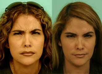BOTOX1