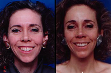 BOTOX3-4