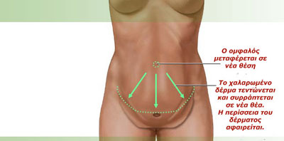 koilioplastki-hristopoulos