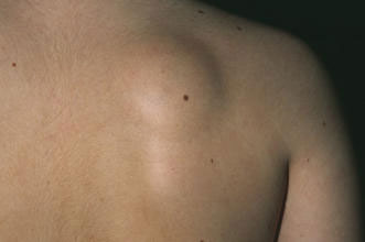 lipoma2-xristopoulos