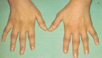 r.arthritida-4