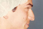 rinoplastiki-6-prin