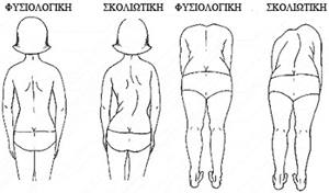 skoliosi1